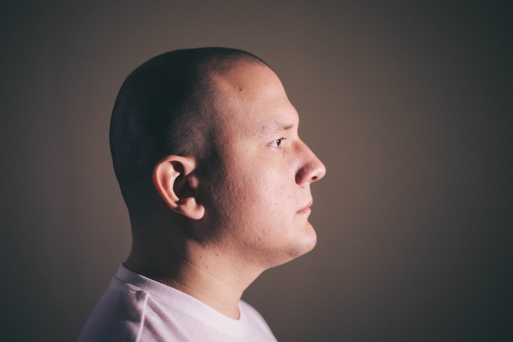 Treatment of Male Pattern Baldness